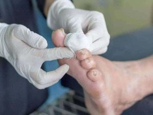 درمان زخم پای دیابتی در منزل